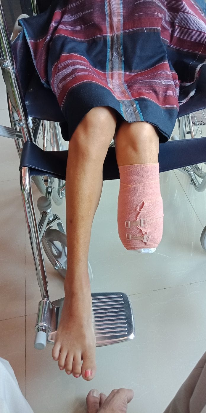 Harapan Medika Makassar Sebagai Pusat Informasi Pembuatan Kaki Palsu Makassar dan Tangan Palsu Makassar, serta alat bantu Ortopedi lainnya Alamat Pembuat Kaki Palsu Makassar dan Tangan Palsu Makassar Alamat Office : RS. Dr. Wahidin Sudirohusodo Unit Rehabilitasi Medik, Jl. Perintis Kemerdekaan KM.11, Makassar Alamat WorkShop : City Of Darul Istiqamah, Jalan Poros Makassar - Maros KM 25 | Telp : 085394849766