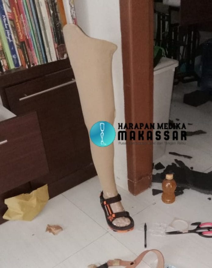 MANFAAT SOKET SILIKON UNTUK KAKI PALSU ATAS LUTUT