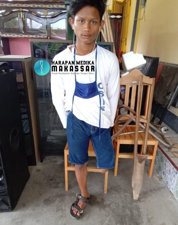 PERJUANGAN HIDUP PASIEN AMPUTASI KAKI SEJAK LAHIR MENDAPATKAN KAKI PALSU DARI GORONTALO
