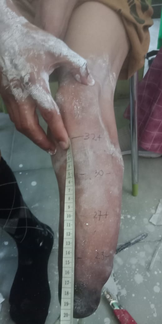 APA BENAR KAKI SAYA DIAMPUTASI KARENA ROKOK