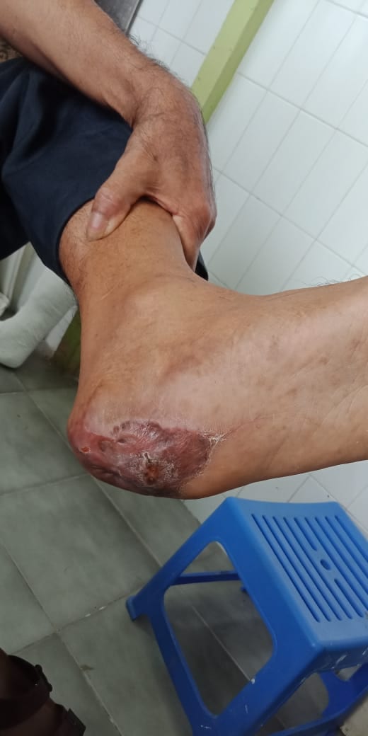 PENANGANAN KHUSUS LATIHAN KAKI PALSU UNTUK PASIEN DIABETES