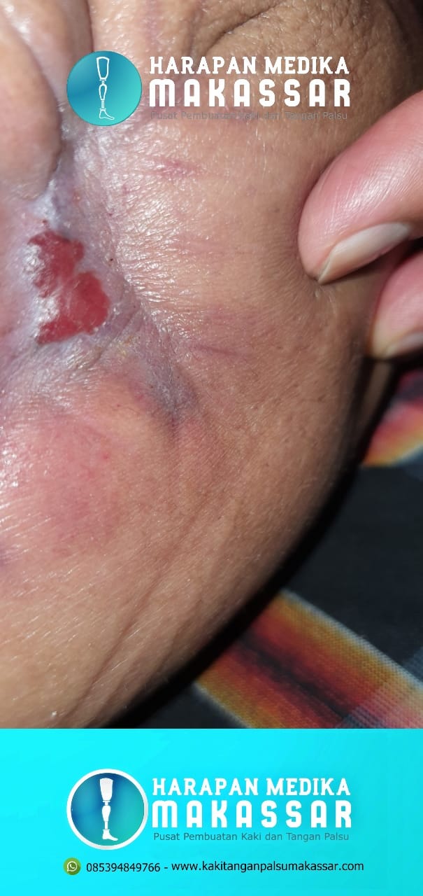 CARA MUDAH MELAKUKAN PERAWATAN LUKA SELAMA PEMAKAIAN KAKI PALSU