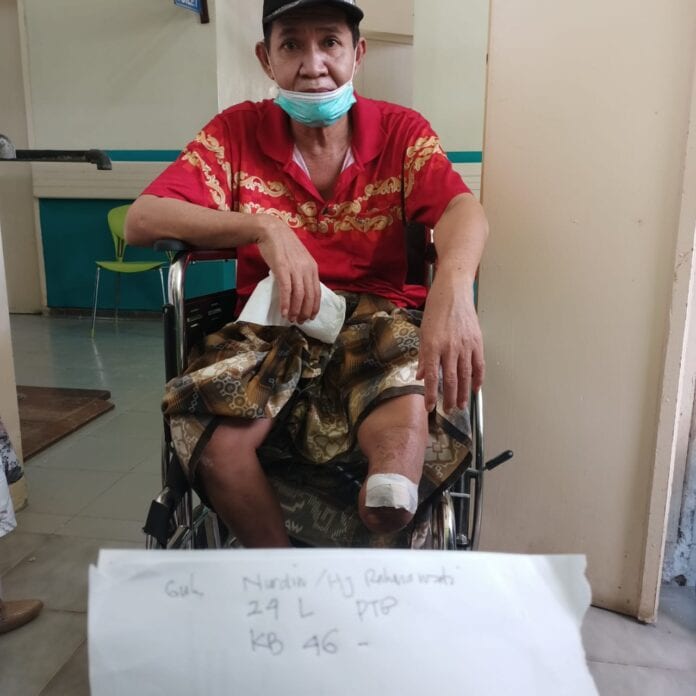 kaki palsu makassar Amputasi Kaki