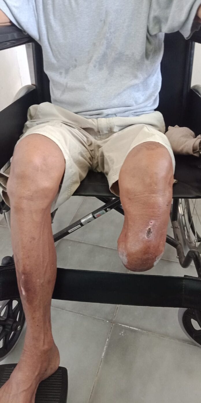 INI KEBIASAAN PENCETUS LUKA AMPUTASI KAKI TAK KUNJUNG SEMBUH