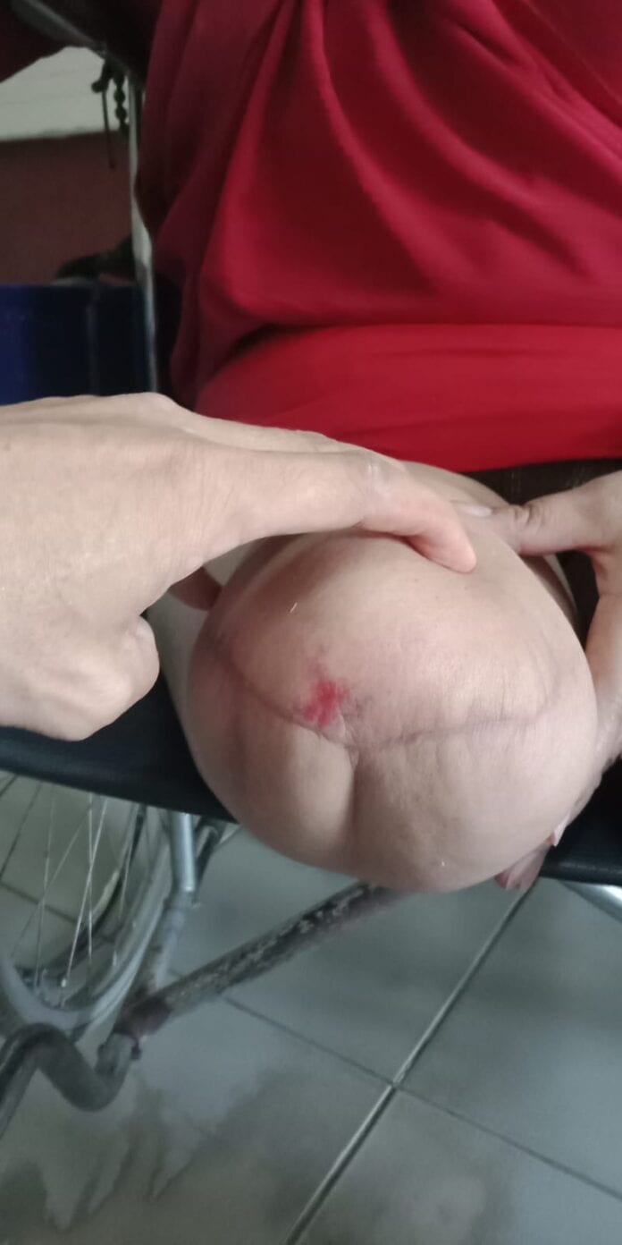 Luka Setelah Amputasi