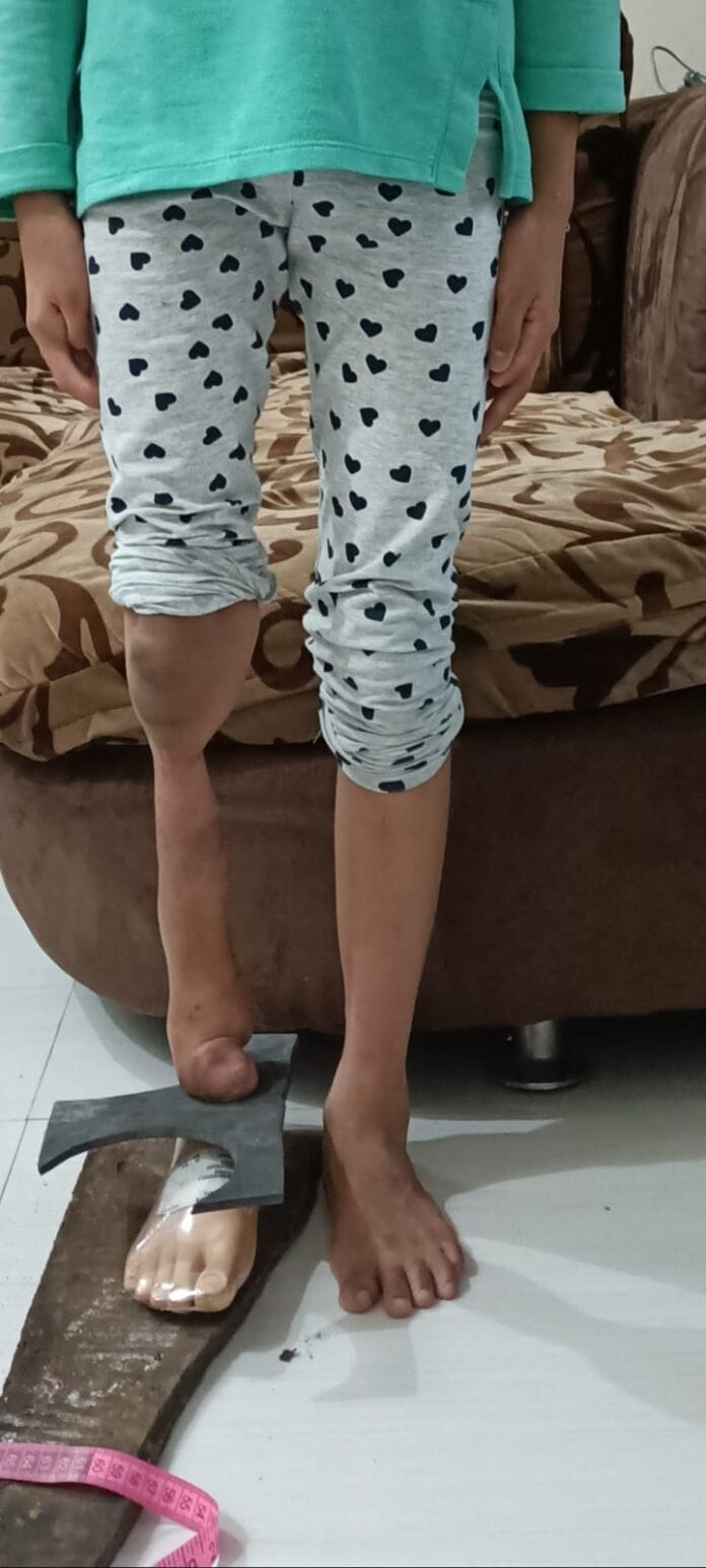 SEKELUMIT PERJUANGAN HIDUP PANTANG MENYERAH PASIEN DISABILITAS