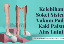 Soket Kaki Palsu Atas Lutut Model Vakum: Keunggulan & Cara Pembuatan KELEBIHAN SOKET SISTEM VAKUM PADA KAKI PALSU ATAS LUTUT