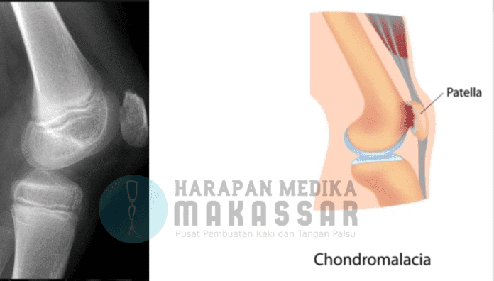 Sakit dan ngilu di persendian lutut saat memakai kaki palsu Sakit dan ngilu di persendian lutut saat memakai kaki palsu