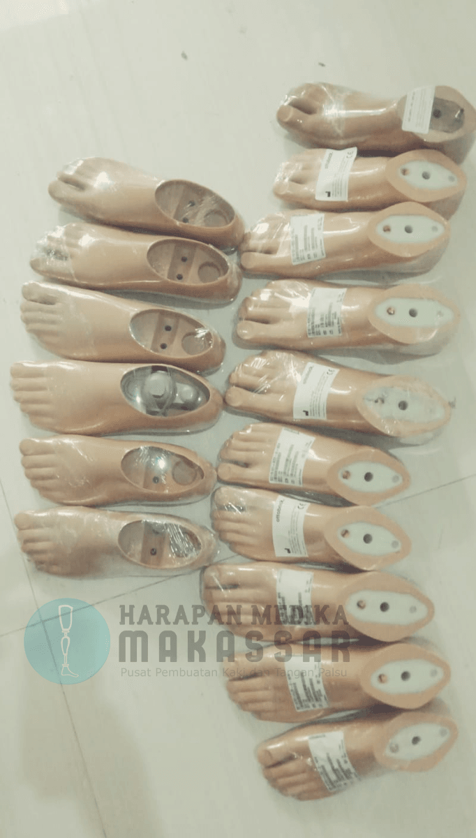 Harga Kaki Palsu Berbeda ! Kok Bisa