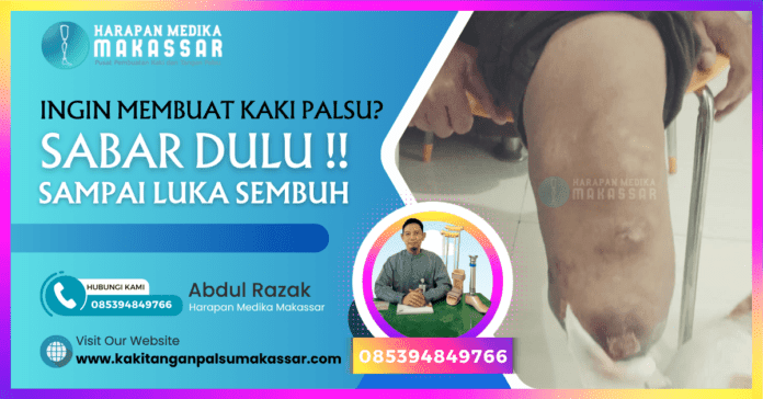 INGIN MEMBUAT KAKI PALSU SABAR DULU SAMPAI LUKA SEMBUH Seorang teknisi kaki palsu sedang memberikan bimbingan kepada seorang pasien diabetes yang menggunakan kaki palsu baru. Pasien berdiri dengan kaki palsu sementara teknisi memberikan panduan tentang cara berjalan dengan hati-hati.