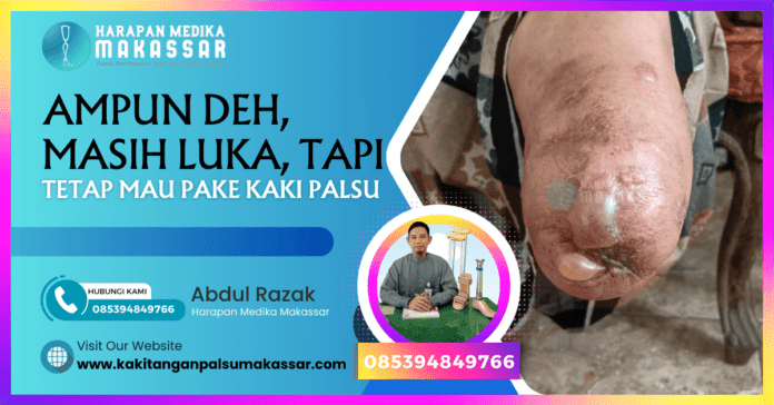 Pentingnya Kesembuhan Luka Sebelum Pemakaian Kaki Palsu dalam Mengatasi Masalah Amputasi Artikel ini membahas pentingnya kesembuhan luka bekas amputasi sebelum mempertimbangkan penggunaan kaki palsu. Kami menjelaskan peran teknisi kaki palsu, tantangan dalam pemulihan, dan cara menghadapinya. Artikel ini juga memberikan informasi mengenai layanan kaki palsu di Makassar dan alat bantu ortopedi lainnya