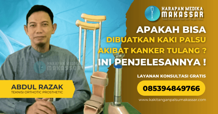 Apakah Bisa Dibuatkan Kaki Palsu Akibat Kanker Tulang Inilah Penjelasannya Apa Bisa Di Buatkan Kaki Palsu Akibat Kanker Tulang ? Ini Penjelasannya !