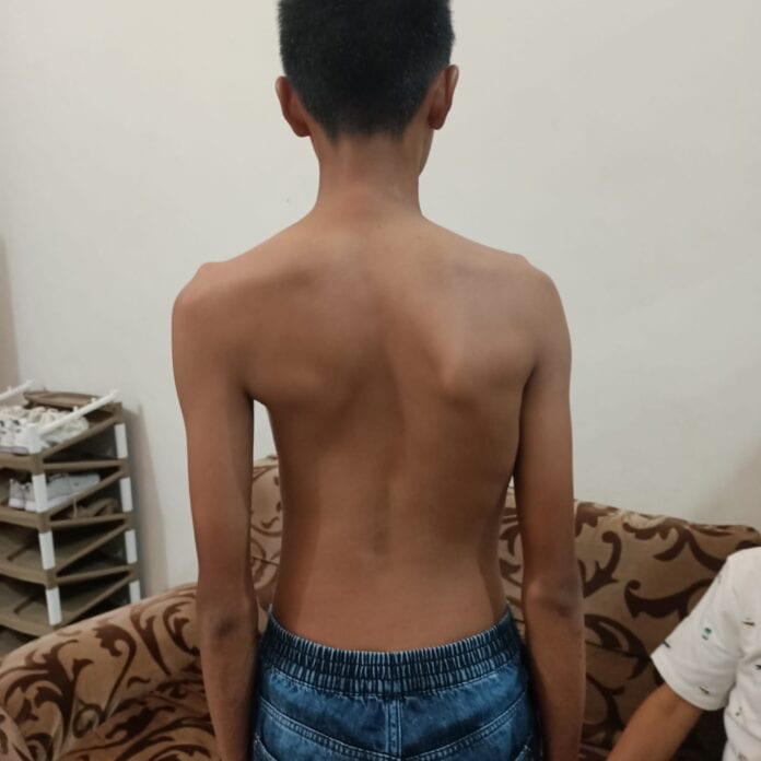 Kenali Kelainan Tulang Belakang yang Membutuhkan Alat Bantu Solusi dan Cara Mengatasinya Kelainan Tulang Belakang