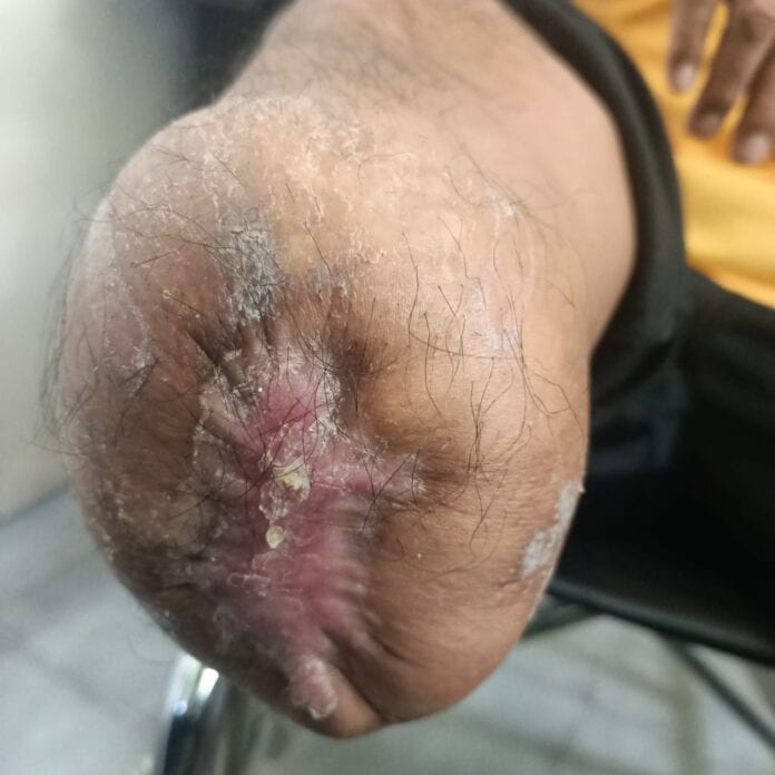 Tips Menghindari Luka Pada Ujung Amputasi Saat Memakai Kaki Palsu