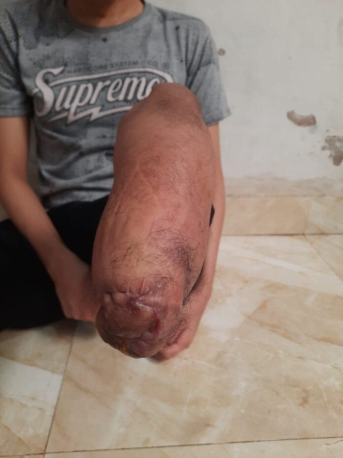 KOK LECET LAGI SIH SETELAH PAKE KAKI PALSU Pelajari penyebab lecet setelah menggunakan kaki palsu dan cari tahu bagaimana cara penanganannya dengan tepat