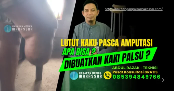 Lutut Kaku Pasca Amputasi, Apa Bisa Dibuatkan Kaki Palsu?