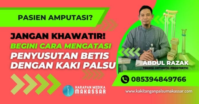 Pakai Kaki Palsu? Begini Trik Supaya Selalu Nyaman Seharian Tanpa Keluhan