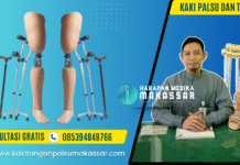 APA BENAR, PASIEN PAKE KAKI PALSU WAJIB LEPAS TONGKAT? Ini Penjelasannya Kaki Palsu dan Tongkat
