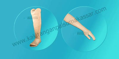 Kaki Palsu Makassar - Tangan Palsu Makassar - Hubungi 085394849766