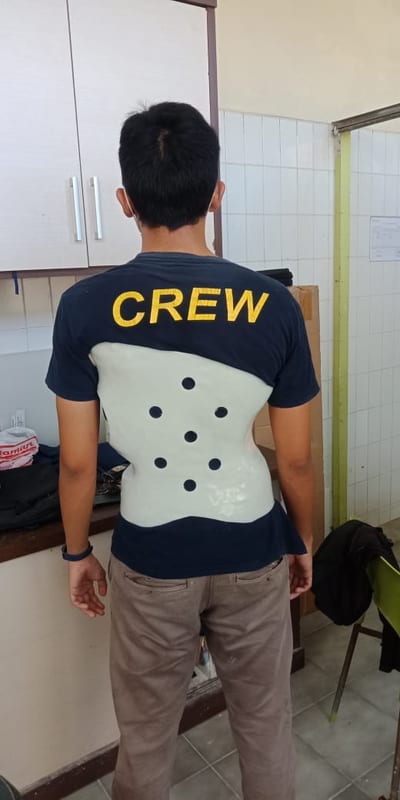 KETAHUILAH MANFAAT BRACE UNTUK PASIEN SCOLIOSIS
