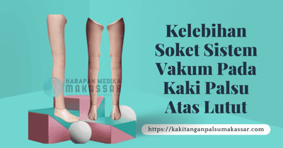 KELEBIHAN SOKET SISTEM VAKUM PADA KAKI PALSU ATAS LUTUT