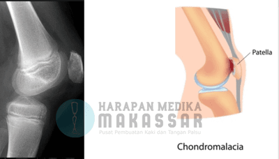 Sakit dan ngilu di persendian lutut saat memakai kaki palsu