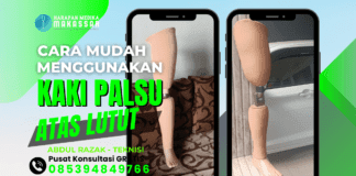 Hal yang Perlu Anda Ketahui Seputar Kaki Palsu Atas Lutut (Transfemoral Prosthesis) Temukan Cara Optimal Menggunakan Kaki Palsu Atas Lutut di Sini!