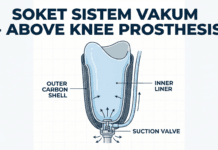 Pentingnya Memilih Soket Kaki Palsu Atas Lutut Vakum untuk Kenyamanan Pentingnya Memilih Soket Kaki Palsu Atas Lutut Vakum untuk Kenyamanan