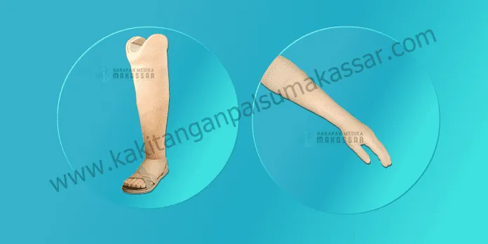 Kaki Palsu Makassar - Tangan Palsu Makassar - Hubungi 085394849766