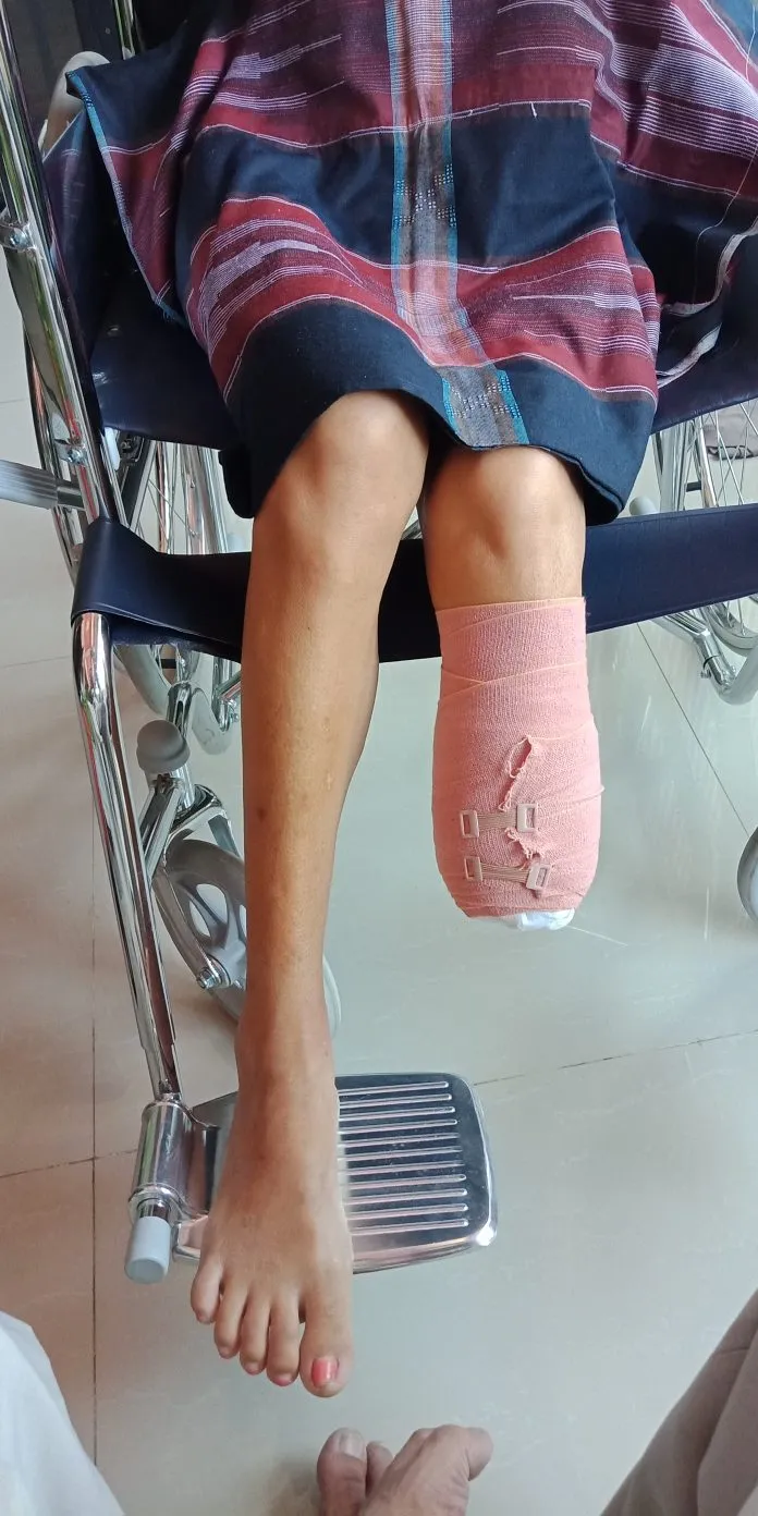 Harapan Medika Makassar Sebagai Pusat Informasi Pembuatan Kaki Palsu Makassar dan Tangan Palsu Makassar, serta alat bantu Ortopedi lainnya Alamat Pembuat Kaki Palsu Makassar dan Tangan Palsu Makassar Alamat Office : RS. Dr. Wahidin Sudirohusodo Unit Rehabilitasi Medik, Jl. Perintis Kemerdekaan KM.11, Makassar Alamat WorkShop : City Of Darul Istiqamah, Jalan Poros Makassar - Maros KM 25 | Telp : 085394849766