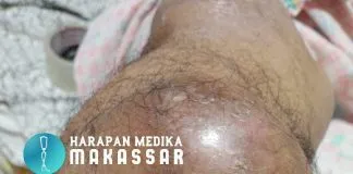 MENGAPA ANDA HARUS MENUNGGU MINIMAL 3 BULAN UNTUK DI BUATKAN KAKI PALSU SETELAH AMPUTASI KAKI