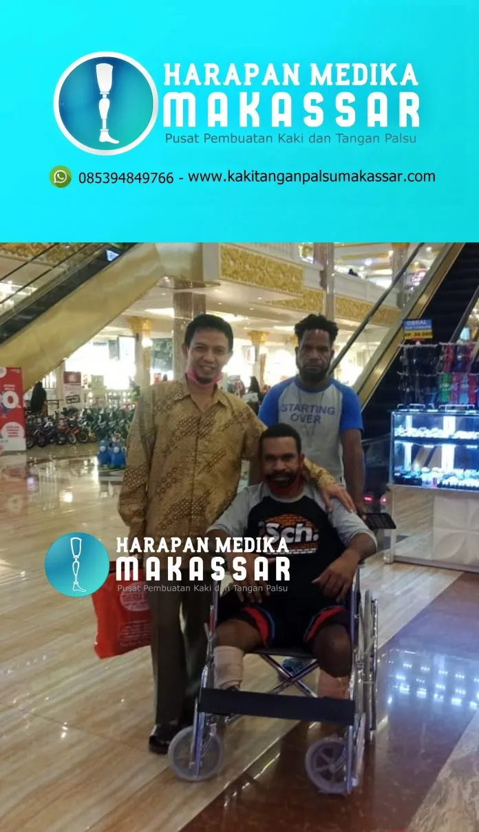 PROSES PEMBUATAN KAKI PALSU PASIEN DARI BALIKPAPAN, KOTA BARU, SAMARINDA DAN BANJARMASIN