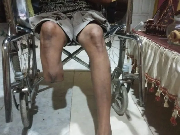 FAKTOR PENYEBAB TIMBULNYA LUKA SELAMA PEMAKAIAN KAKI PALSU