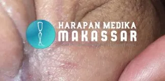 CARA MUDAH MELAKUKAN PERAWATAN LUKA SELAMA PEMAKAIAN KAKI PALSU CARA MUDAH MELAKUKAN PERAWATAN LUKA SELAMA PEMAKAIAN KAKI PALSU