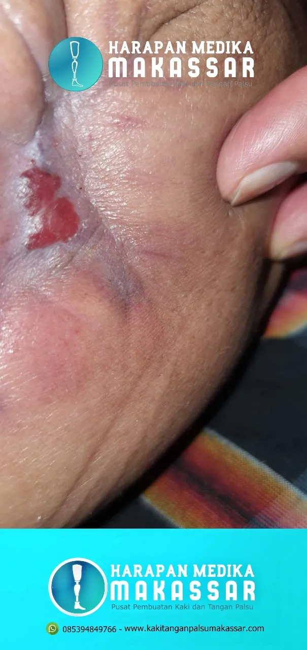 CARA MUDAH MELAKUKAN PERAWATAN LUKA SELAMA PEMAKAIAN KAKI PALSU