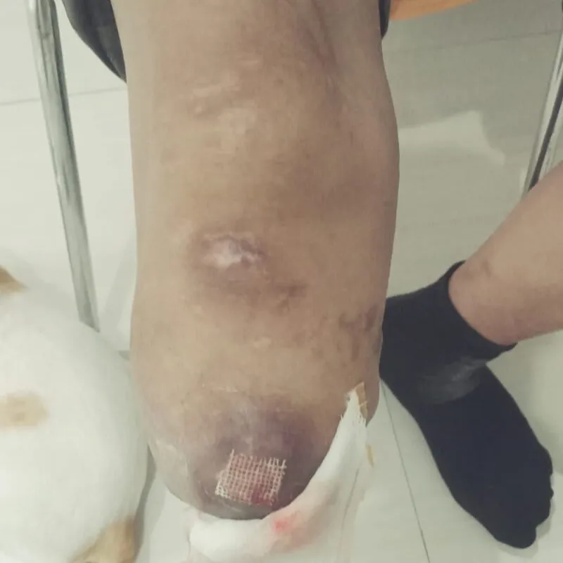 KAKI TERASA GATAL, KRAM ATAU SAKIT PADAHAL SUDAH DI AMPUTASI? INI PENJELASANNYA!