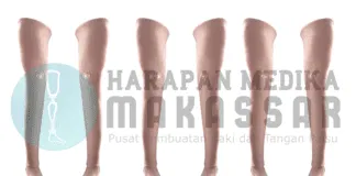 ALUR PELAYANAN PEMBUATAN KAKI PALSU ATAS LUTUT Kaki Palsu Kualitas Terbaik