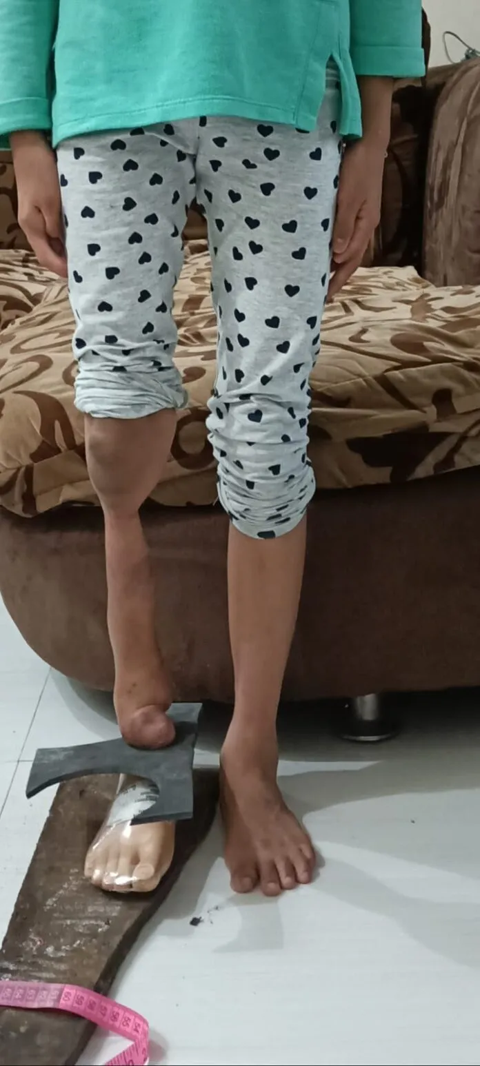 Pasien Disailitas SEKELUMIT PERJUANGAN HIDUP PANTANG MENYERAH PASIEN DISABILITAS