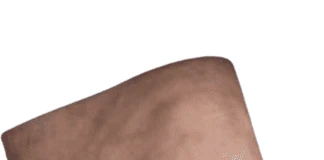 Timbul jaringan parut Scar Tissue pada bekas jahitan amputasi anda ? Ini tips menggunakan kaki palsu