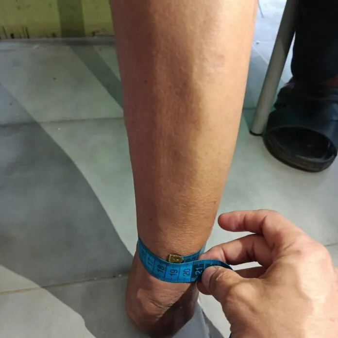 kaki palsu syme prosthesis