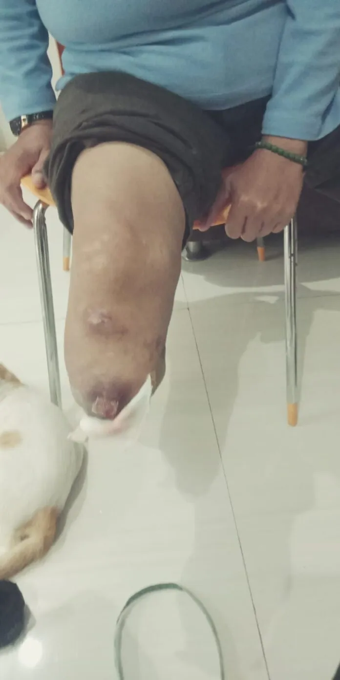 Luka Amputasi Tak Kunjung Sembuh ? Jangan Panik