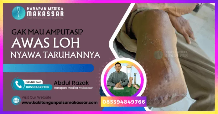 GAK MAU AMPUTASI AWAS LOH NYAWA TARUHANNYA