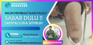 INGIN MEMBUAT KAKI PALSU? SABAR DULU SAMPAI LUKA SEMBUH Seorang teknisi kaki palsu sedang memberikan bimbingan kepada seorang pasien diabetes yang menggunakan kaki palsu baru. Pasien berdiri dengan kaki palsu sementara teknisi memberikan panduan tentang cara berjalan dengan hati-hati.