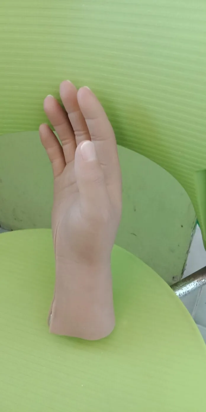 Memang Beda Yach Manfaat Kaki Palsu dan Tangan Palsu