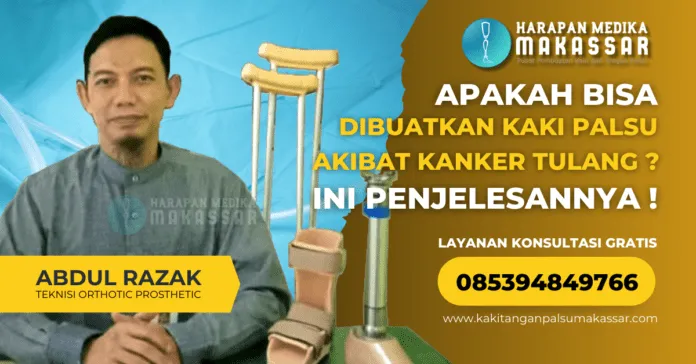 Apakah Bisa Dibuatkan Kaki Palsu Akibat Kanker Tulang Inilah Penjelasannya Apa Bisa Di Buatkan Kaki Palsu Akibat Kanker Tulang ? Ini Penjelasannya !