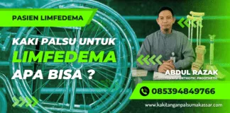 Pasien Limfedema: Pembuatan Kaki Palsu untuk Penderita Penyakit Limfedema Kaki Gajah, Apa Bisa ? menggunakan kaki palsu saat melakukan latihan rehabilitasi untuk mengatasi limfedema yang disebabkan oleh kaki gajah