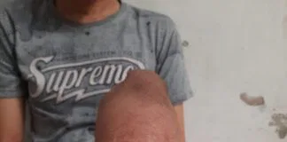 Kamu Pernah Mengalami Lecet Bagian Luka Setelah Menggunakan Kaki Palsu? Begini Solusinya : Pelajari penyebab lecet setelah menggunakan kaki palsu dan cari tahu bagaimana cara penanganannya dengan tepat