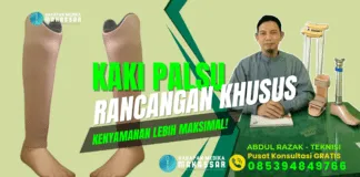 PERLUKAH PAKAI SABUK UNTUK KAKI PALSU BAWAH LUTUT? Kaki palsu tanpa sabuk, lebih nyaman untuk aktivitas harian! Melangkah stabil tanpa ribet, solusi modern untuk amputasi bawah lutut! Bebas bergerak, kaki palsu bawah lutut terbaik untuk Anda! Hidup baru dimulai dengan langkah yang lebih percaya diri! Rasakan teknologi kaki palsu modern, nyaman dan simpel digunakan! Prostetik tanpa sabuk, langkah ringan untuk hari yang ceria! Solusi prostetik canggih, mobilitas maksimal tanpa batas! Desain inovatif, nyaman dipakai, cocok untuk kebutuhan Anda! Langkah pasti, nyaman, dan stabil dengan kaki palsu modern! Kembali aktif dengan kaki palsu yang dirancang khusus untuk Anda!