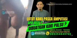 Lutut Kaku Pasca Amputasi, Apa Bisa Dibuatkan Kaki Palsu? Lutut Kaku Pasca Amputasi, Apa Bisa Dibuatkan Kaki Palsu?