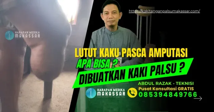 Lutut Kaku Pasca Amputasi, Apa Bisa Dibuatkan Kaki Palsu Lutut Kaku Pasca Amputasi, Apa Bisa Dibuatkan Kaki Palsu?